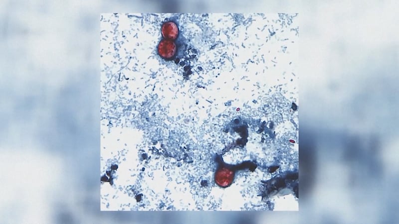 Local doctor issues warning on cyclospora, ‘explosive diarrhea parasite’